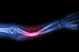 TheMerkle Broken Bone 3D Cast