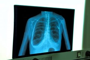 TheMerkle Artificial Lung