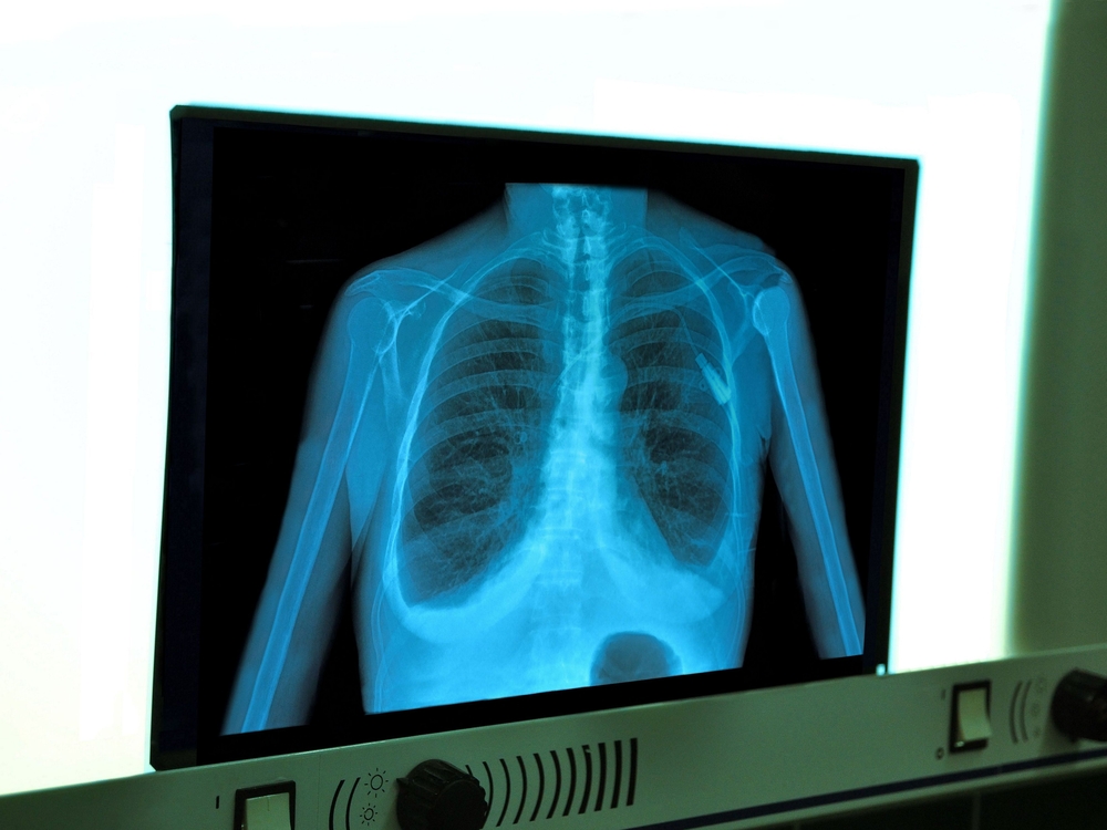TheMerkle Artificial Lung