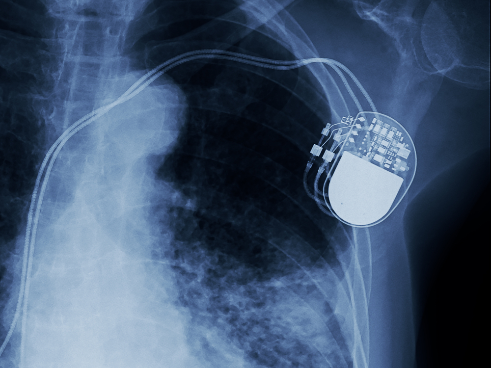 TheMerkle Pacemaker Vulnerabilities